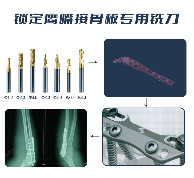 鎖定鷹嘴接骨板應用 (1)