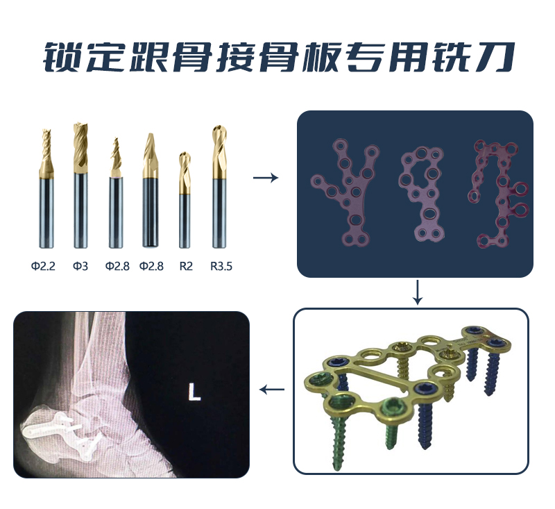 鎖定跟骨接骨板應(yīng)用 集合(1)1